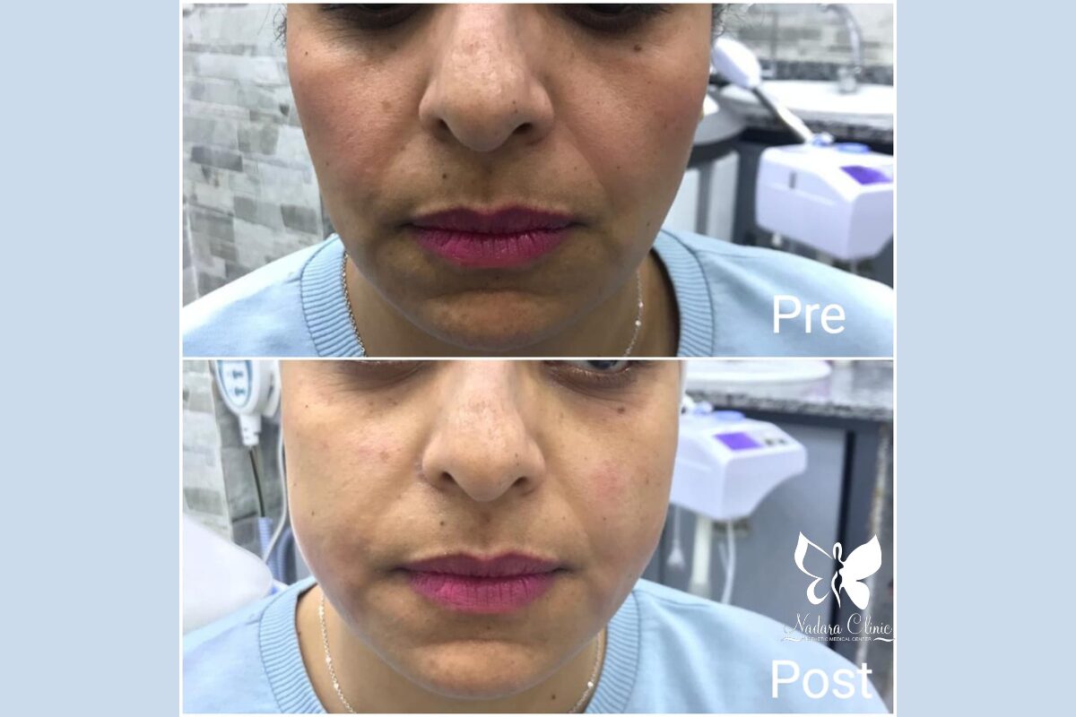 هايفو لشد الوجه